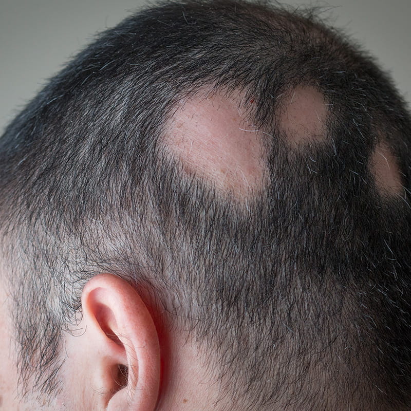 A white man with alopecia areata has circular patches of missing hair on the back of his head