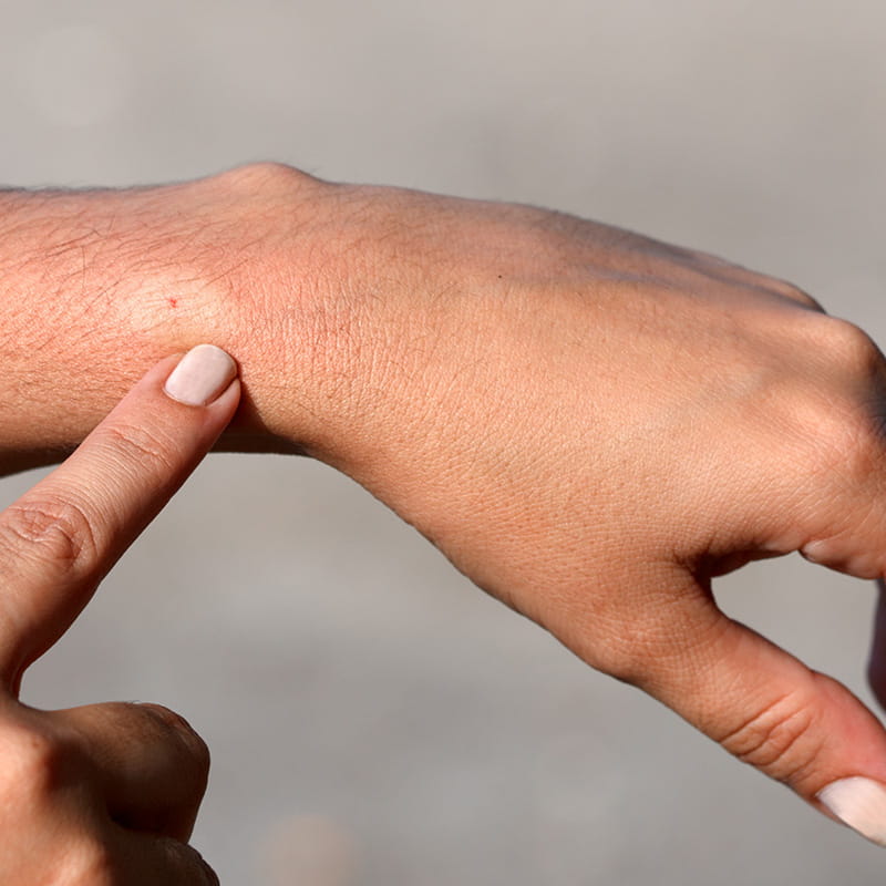 Hand pointing to a persons wrist where they have a bee sting