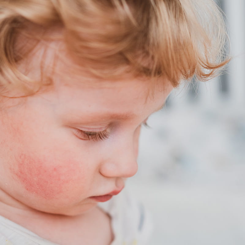 A young white child with a red rash on his cheek
